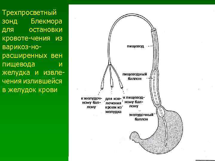 Трехпросветный зонд Блекмора для остановки кровоте-чения из варикоз-но- пищевод расширенных вен пищевода и желудка