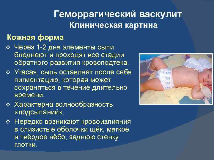 Геморрагический васкулит Клиническая картина Кожная форма Через 1 -2 дня элементы сыпи бледнеют и