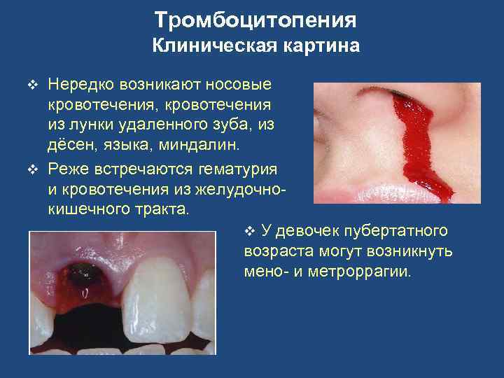 Тромбоцитопения Клиническая картина Нередко возникают носовые кровотечения, кровотечения из лунки удаленного зуба, из дёсен,