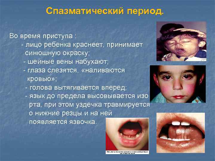 Спазматический период. Во время приступа : - лицо ребенка краснеет, принимает синюшную окраску; -