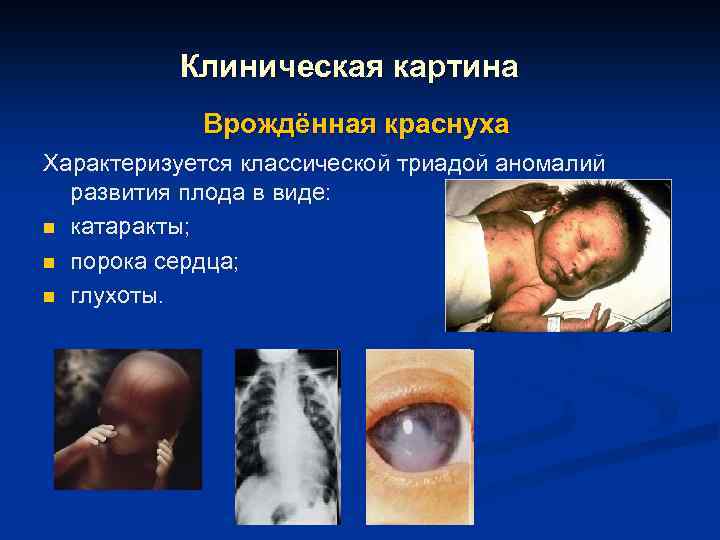 Клиническая картина Врождённая краснуха Характеризуется классической триадой аномалий развития плода в виде: n катаракты;