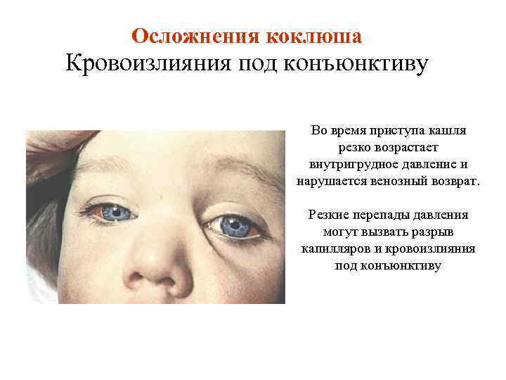 Осложнения коклюша Кровоизлияния под конъюнктиву Во время приступа кашля резко возрастает внутригрудное давление и