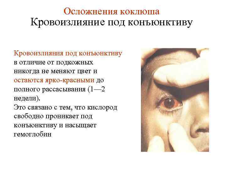 Осложнения коклюша Кровоизлияние под конъюнктиву Кровоизлияния под конъюнктиву в отличие от подкожных никогда не