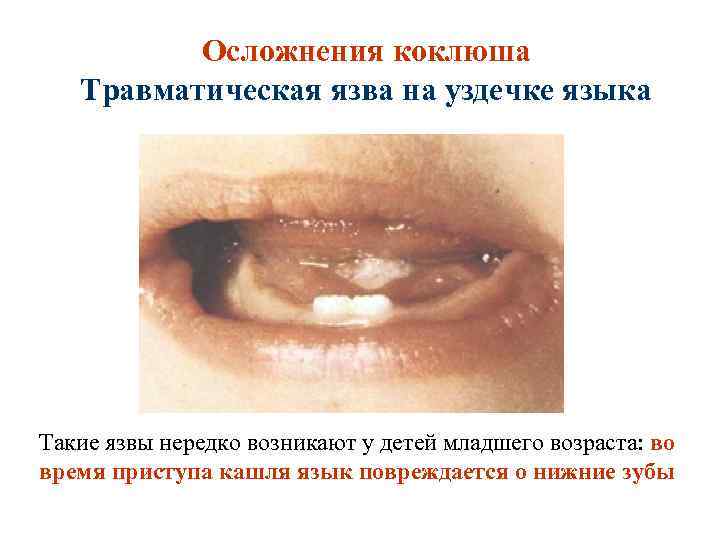 Осложнения коклюша Травматическая язва на уздечке языка Такие язвы нередко возникают у детей младшего
