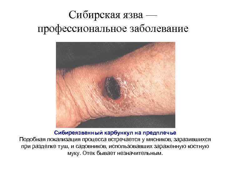 Сибирская язва — профессиональное заболевание Сибиреязвенный карбункул на предплечье Подобная локализация процесса встречается у
