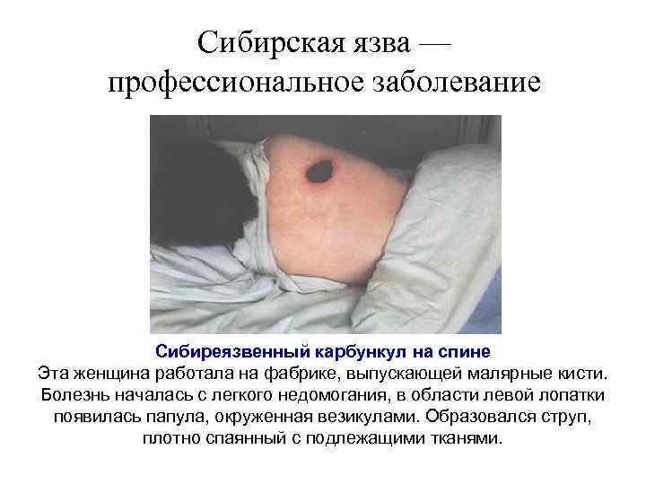 Сибирская язва — профессиональное заболевание Сибиреязвенный карбункул на спине Эта женщина работала на фабрике,