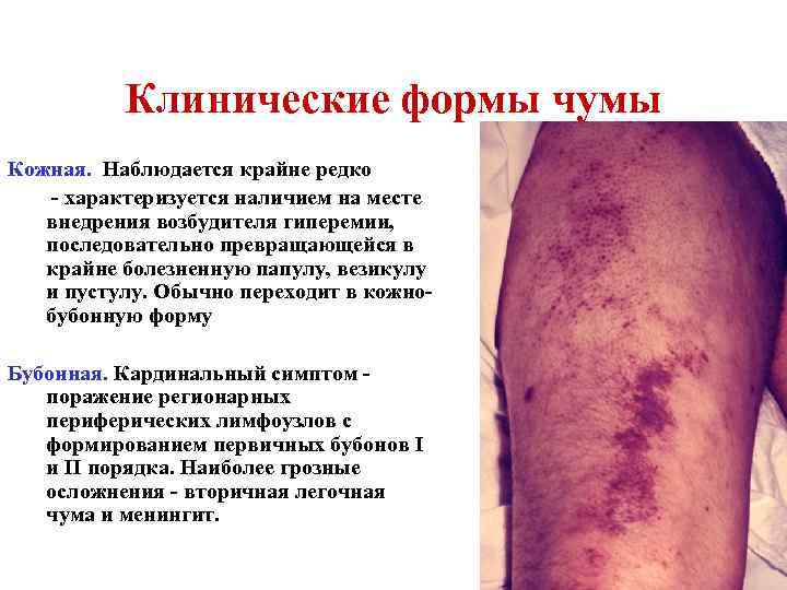 Клинические формы чумы Кожная. Наблюдается крайне редко - характеризуется наличием на месте внедрения возбудителя