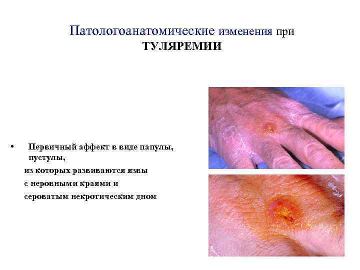 Патологоанатомические изменения при ТУЛЯРЕМИИ • Первичный аффект в виде папулы, пустулы, из которых развиваются