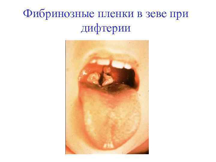Фибринозные пленки в зеве при дифтерии 