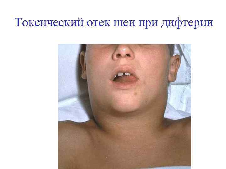Токсический отек шеи при дифтерии 