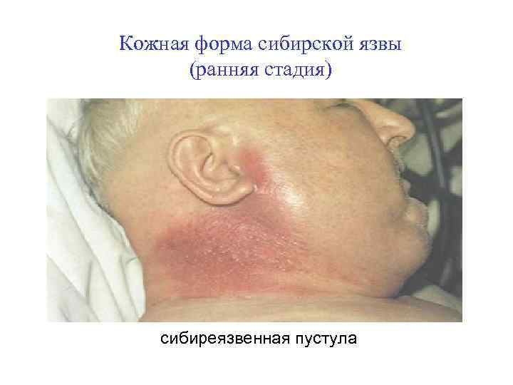 Кожная форма сибирской язвы (ранняя стадия) сибиреязвенная пустула 