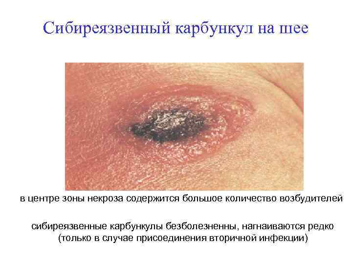 Сибиреязвенный карбункул на шее в центре зоны некроза содержится большое количество возбудителей сибиреязвенные карбункулы