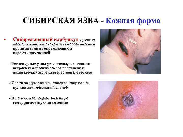 СИБИРСКАЯ ЯЗВА - Кожная форма • Сибиреязвенный карбункул с резким воспалительным отеком и геморрагическим