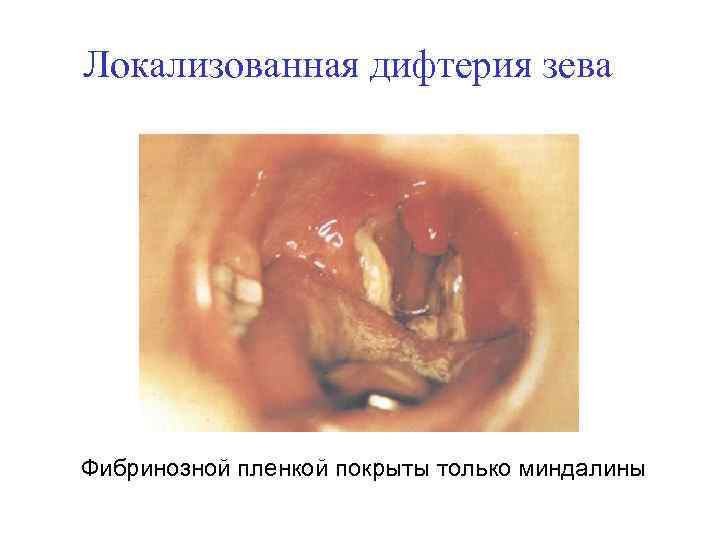 Локализованная дифтерия зева Фибринозной пленкой покрыты только миндалины 