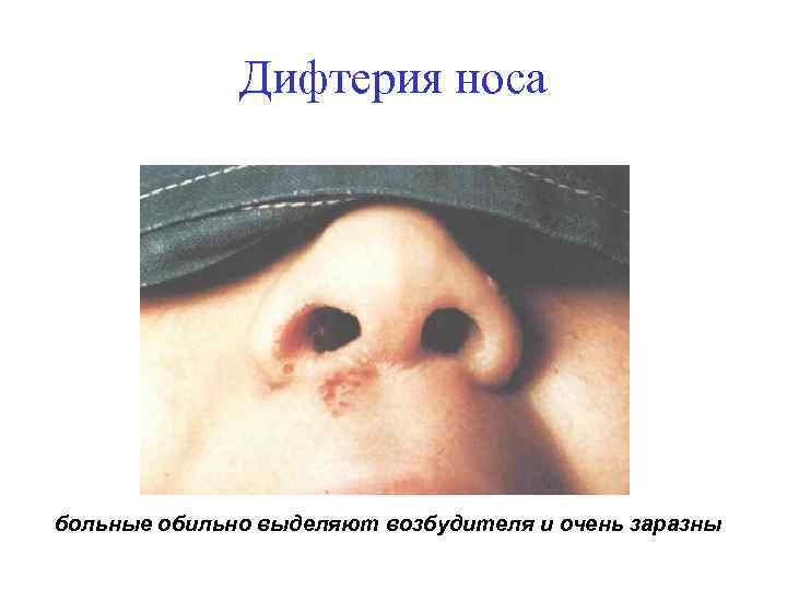 Дифтерия носа больные обильно выделяют возбудителя и очень заразны 