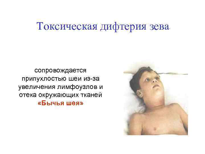 Токсическая дифтерия зева сопровождается припухлостью шеи из-за увеличения лимфоузлов и отека окружающих тканей «Бычья