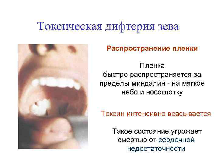 Токсическая дифтерия зева Распространение пленки Пленка быстро распространяется за пределы миндалин - на мягкое