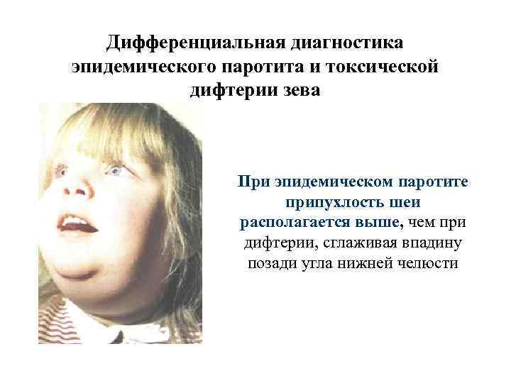 Дифференциальная диагностика эпидемического паротита и токсической дифтерии зева При эпидемическом паротите припухлость шеи располагается