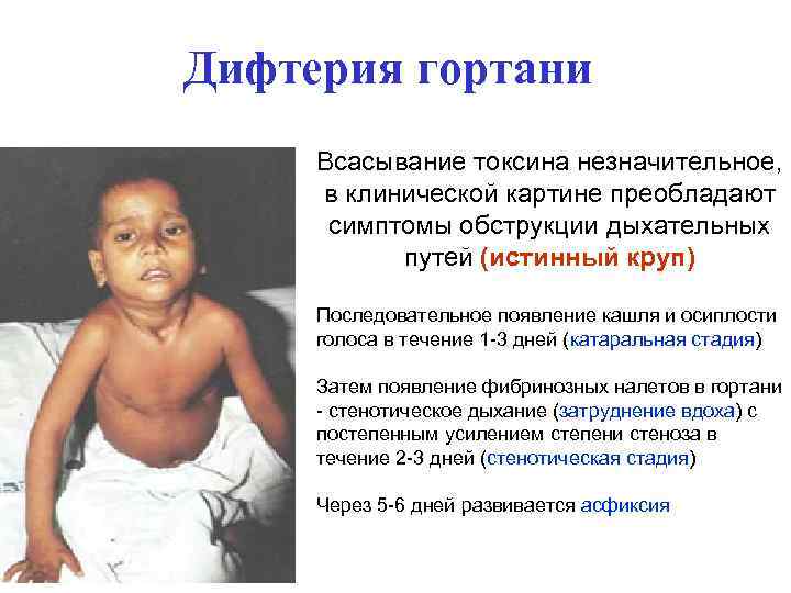 Дифтерия гортани Всасывание токсина незначительное, в клинической картине преобладают симптомы обструкции дыхательных путей (истинный