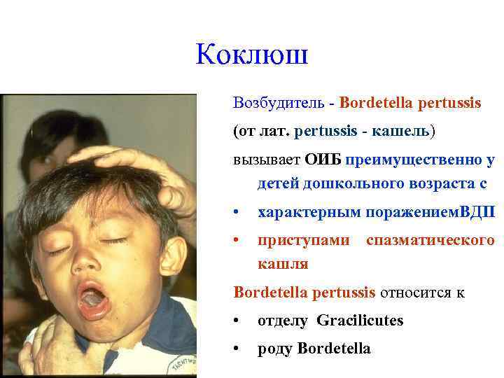 Коклюш Возбудитель - Bordetella pertussis (от лат. pertussis - кашель) вызывает ОИБ преимущественно у