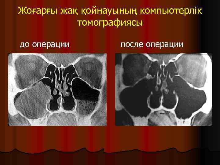 Жоғарғы жақ қойнауының компьютерлік томографиясы до операции после операции 