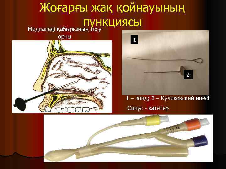 Жоғарғы жақ қойнауының пункциясы Медиальді қабырғаның тесу орны 1 2 1 – зонд; 2