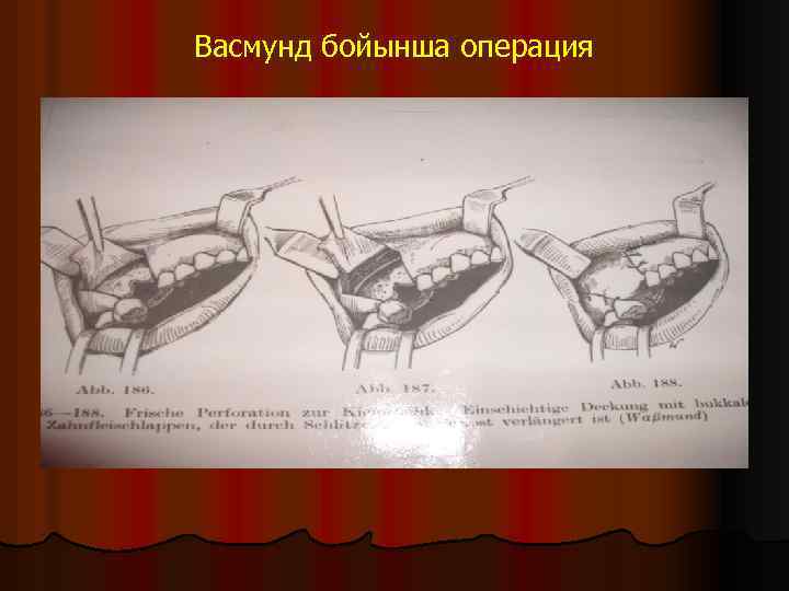 Васмунд бойынша операция 