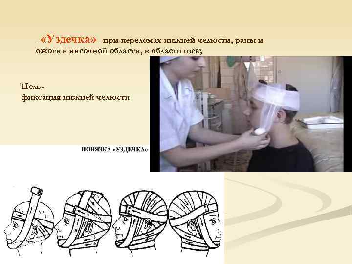 - «Уздечка» - при переломах нижней челюсти, раны и ожоги в височной области, в