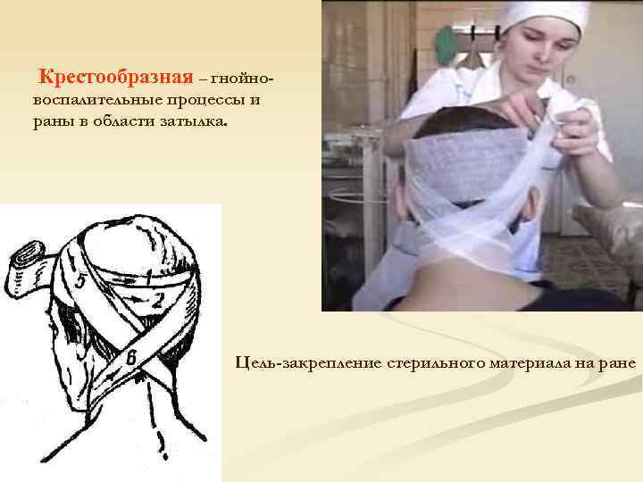 Крестообразная – гнойновоспалительные процессы и раны в области затылка. Цель-закрепление стерильного материала на ране