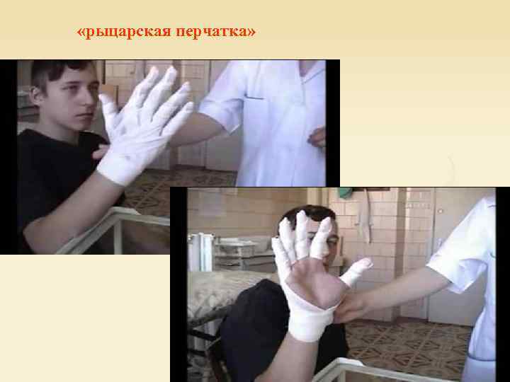  «рыцарская перчатка» 