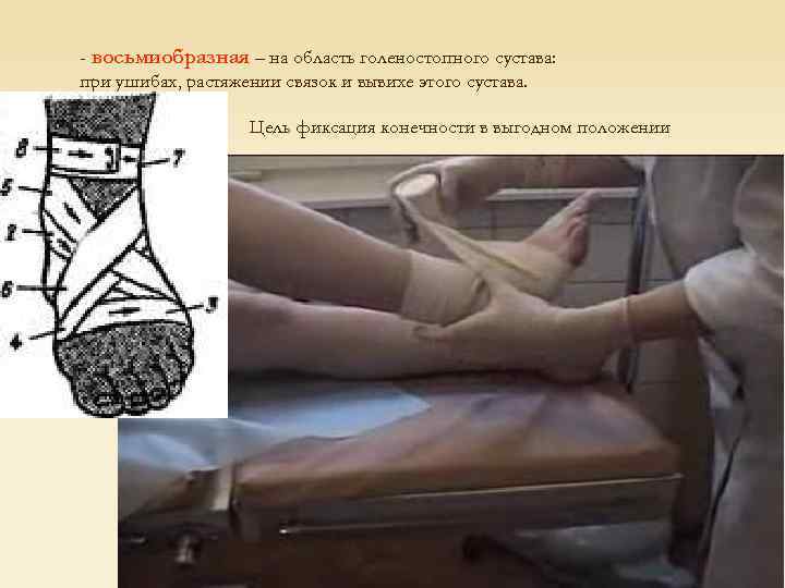 - восьмиобразная – на область голеностопного сустава: при ушибах, растяжении связок и вывихе этого