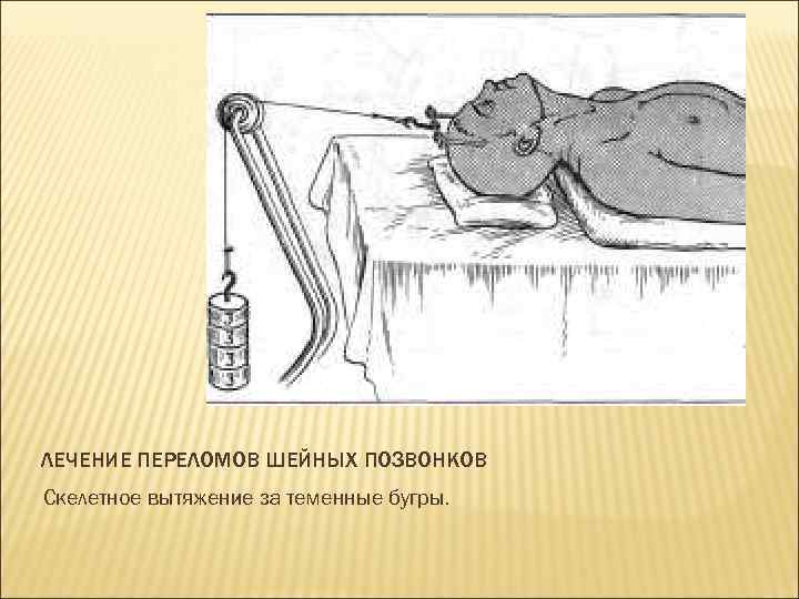 ЛЕЧЕНИЕ ПЕРЕЛОМОВ ШЕЙНЫХ ПОЗВОНКОВ Скелетное вытяжение за теменные бугры. 