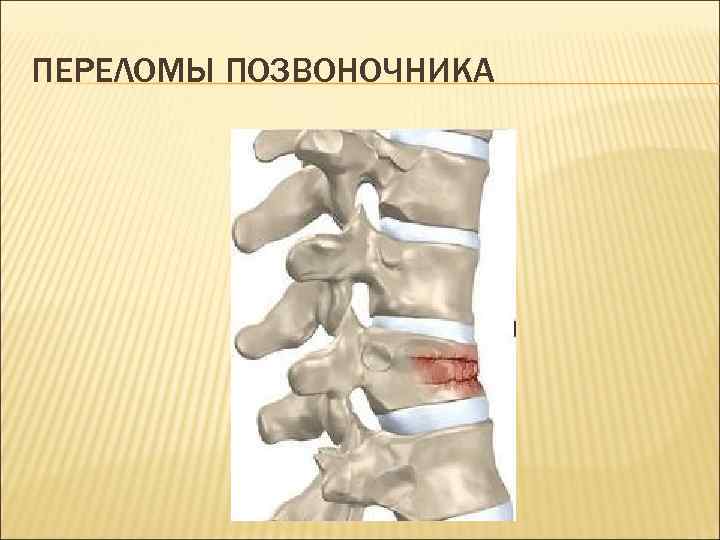 Матрас при переломе позвоночника