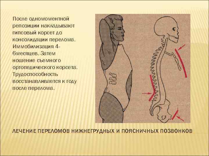 После одномоментной репозиции накладывают гипсовый корсет до консолидации перелома. Иммобилизация 46 месяцев. Затем ношение