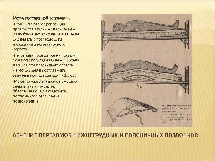 Метод постепенной репозиции. • Принцип метода: репозиция проводится этапным увеличением разгибания позвоночника в течение
