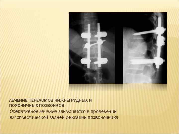 ЛЕЧЕНИЕ ПЕРЕЛОМОВ НИЖНЕГРУДНЫХ И ПОЯСНИЧНЫХ ПОЗВОНКОВ Оперативное лечение заключается в проведении аллопластической задней фиксации