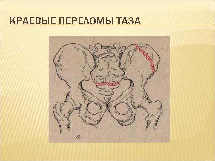 Перелом костей таза карта вызова