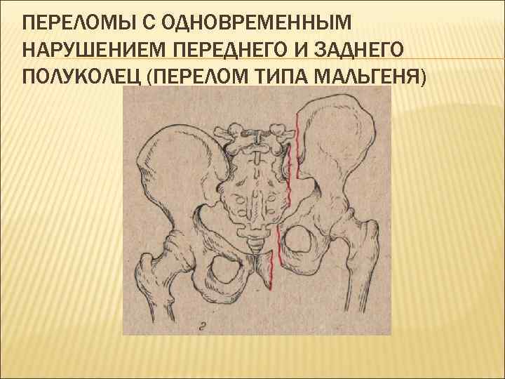 Переломал кости 20 летней беременной