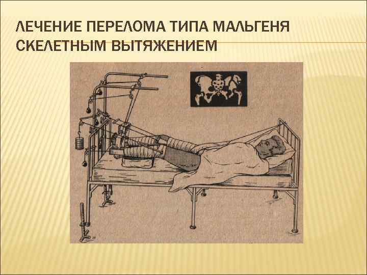 ЛЕЧЕНИЕ ПЕРЕЛОМА ТИПА МАЛЬГЕНЯ СКЕЛЕТНЫМ ВЫТЯЖЕНИЕМ 