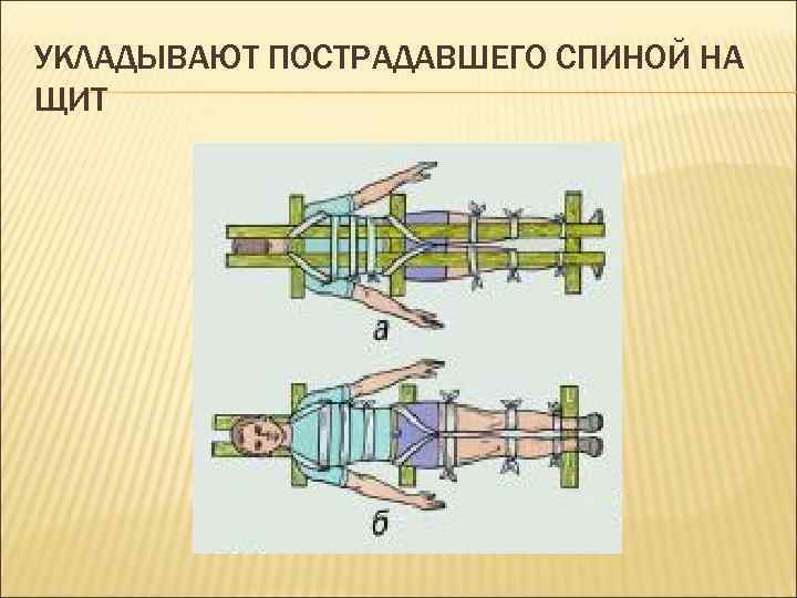 УКЛАДЫВАЮТ ПОСТРАДАВШЕГО СПИНОЙ НА ЩИТ 