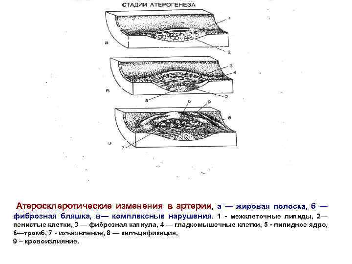  Атеросклеротические изменения в артерии, а — жировая полоска, б — фиброзная бляшка, в—