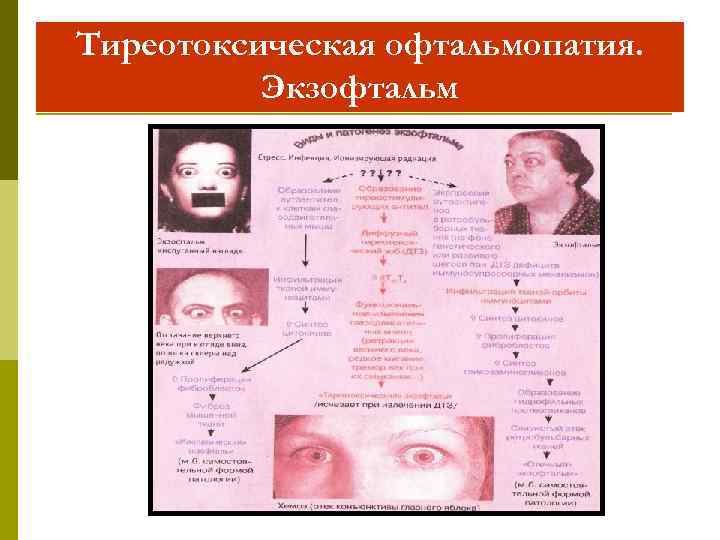 Тиреотоксическая офтальмопатия. Экзофтальм 