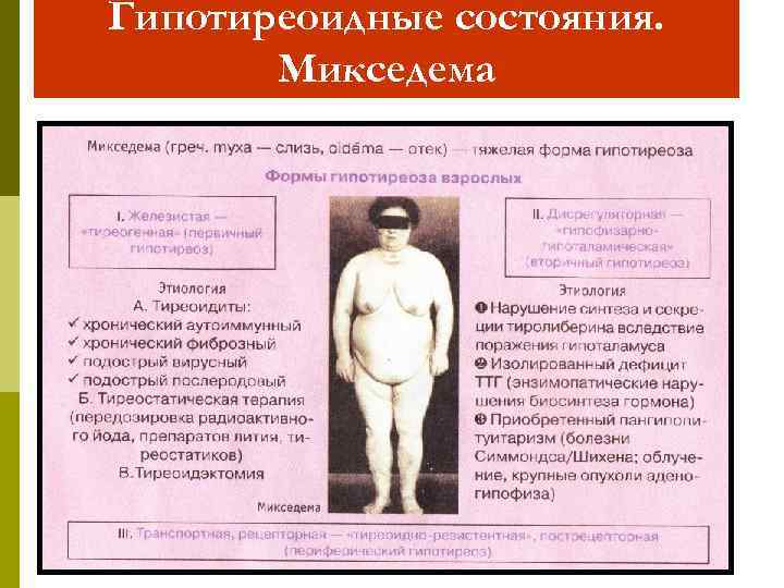 Гипотиреоидные состояния. Микседема 