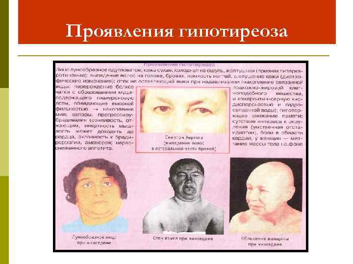 Проявления гипотиреоза 