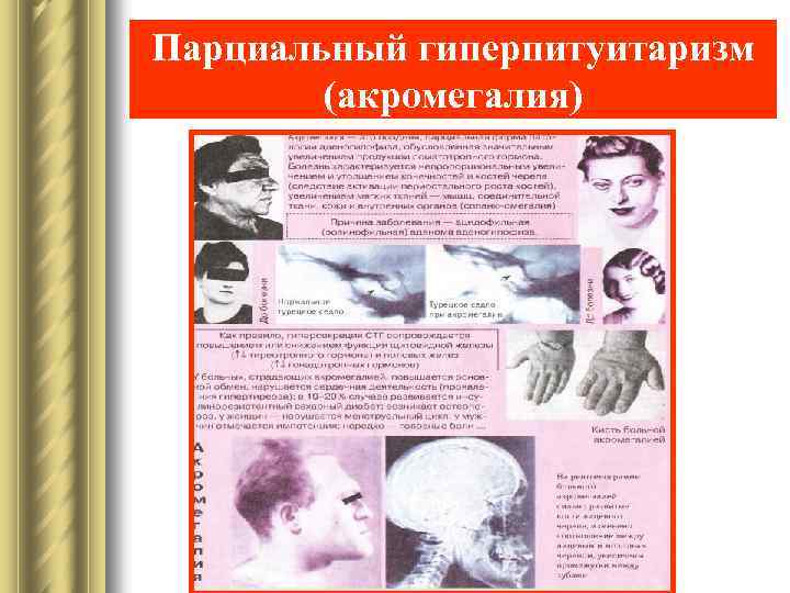 Парциальный гиперпитуитаризм (акромегалия) 