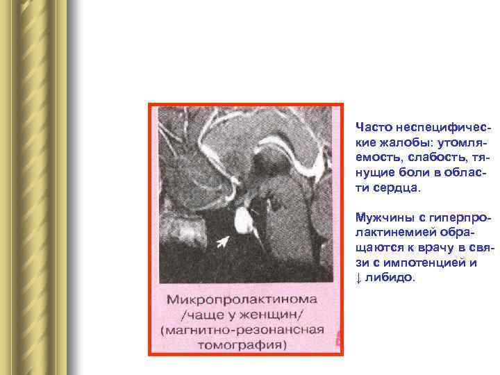 Часто неспецифические жалобы: утомляемость, слабость, тянущие боли в области сердца. Мужчины с гиперпролактинемией обращаются