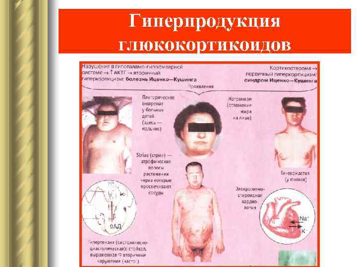 Гиперпродукция глюкокортикоидов 