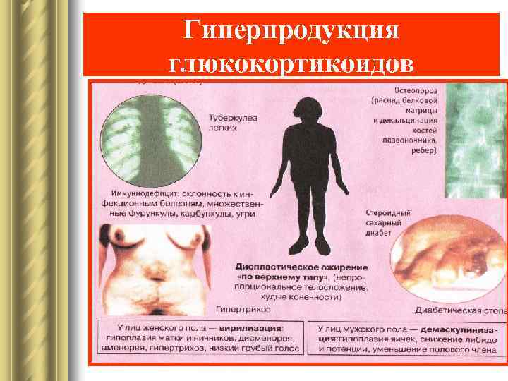 Гиперпродукция глюкокортикоидов 