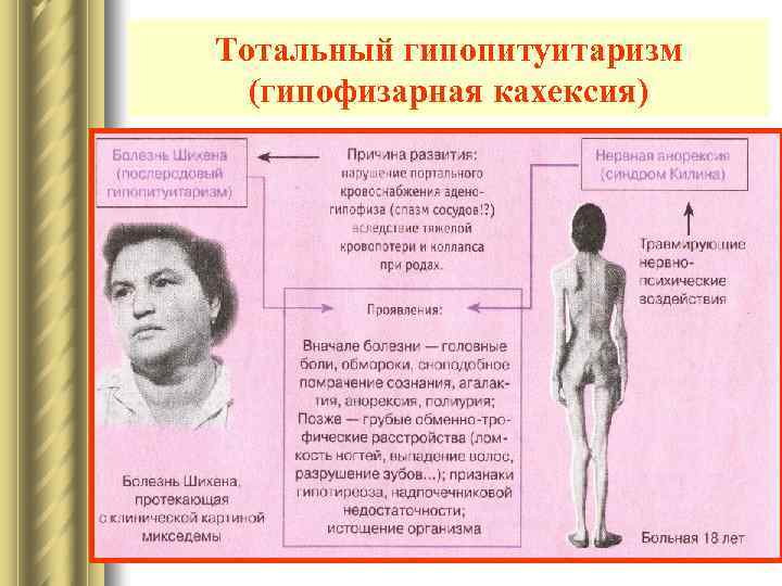 Тотальный гипопитуитаризм (гипофизарная кахексия) 