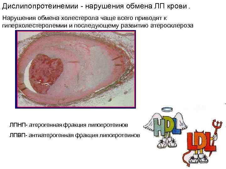 Дислипопротеинемии - нарушения обмена ЛП крови. Нарушения обмена холестерола чаще всего приводят к гиперхолестеролемии